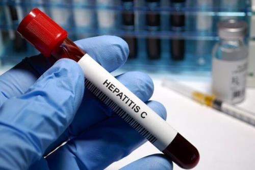 هپاتیت سی در 3 گروه پرخطر در آستانه ریشه کنی در کشور