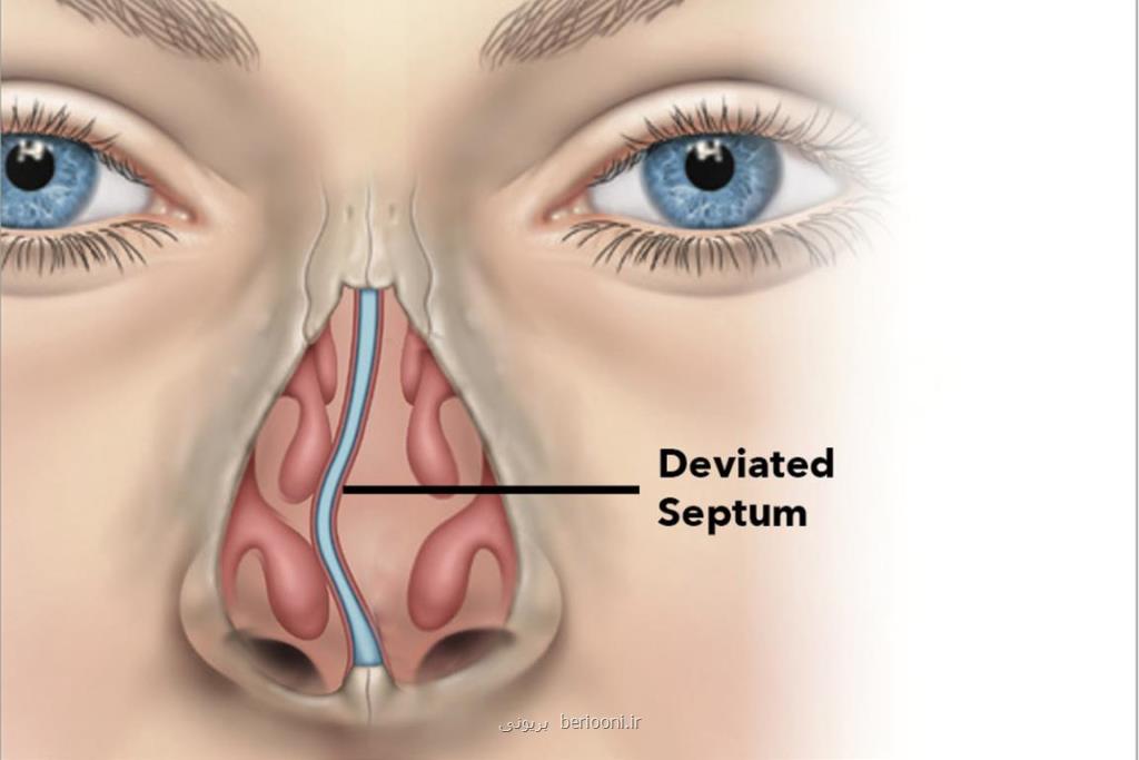 آشنایی با علائم و روش های درمان انحراف بینی و سینوزیت