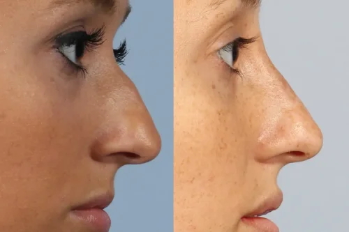 فیلر بینی و هر آنچه پیش از تزریق باید بدانید